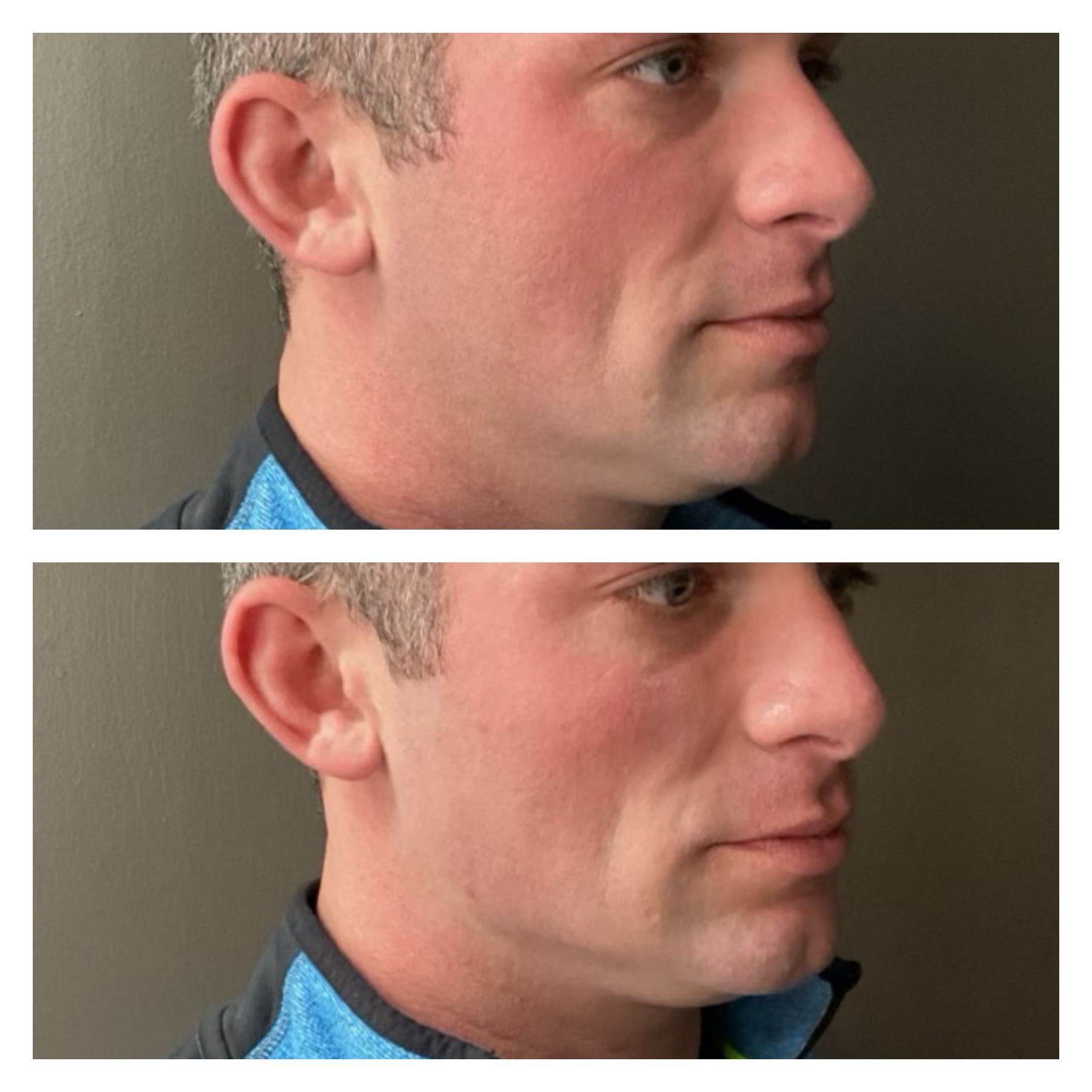 Filler before and after by New Leaf Restorative Medicine