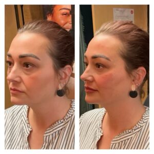 Before and after for 8-point Lift treatment from New Leaf Restorative Medicine