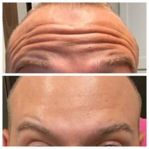 Botox Before and After