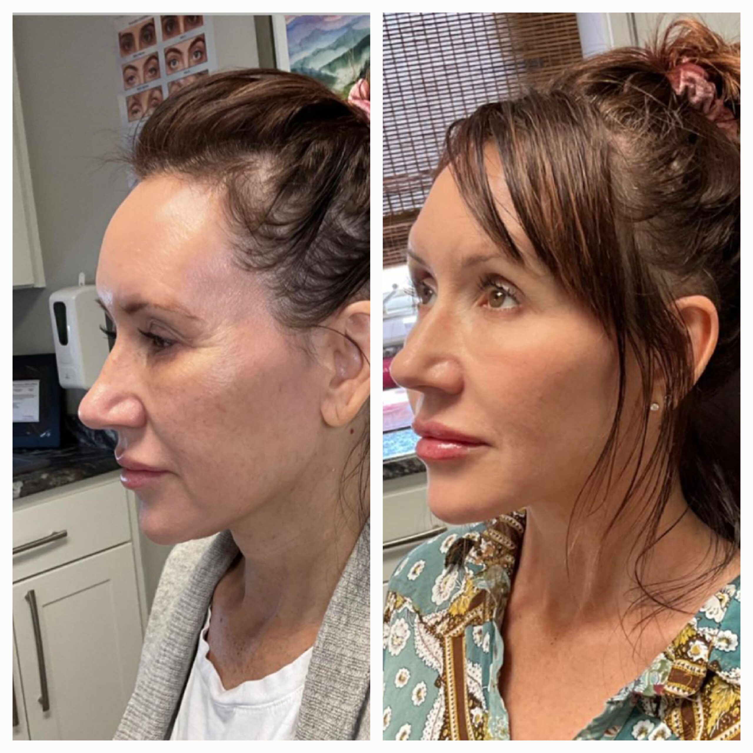 Before and after for 8-point Lift treatment from New Leaf Restorative Medicine-12