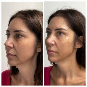 Before and after for 8-point Lift treatment from New Leaf Restorative Medicine- 6