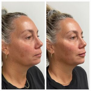 Filler before and after by New Leaf Restorative Medicine