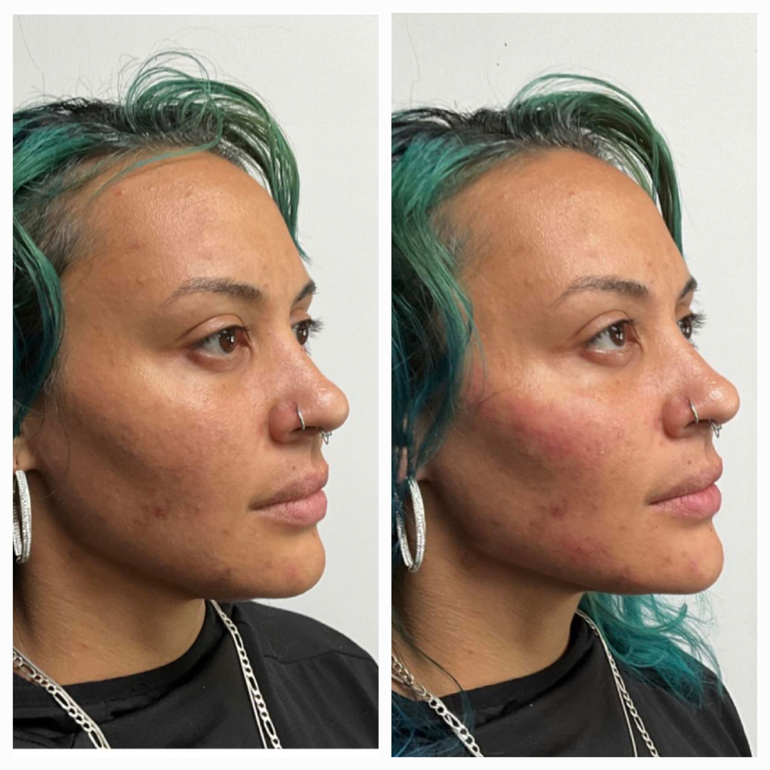 Before and after for 8-point Lift treatment from New Leaf Restorative Medicine- 4