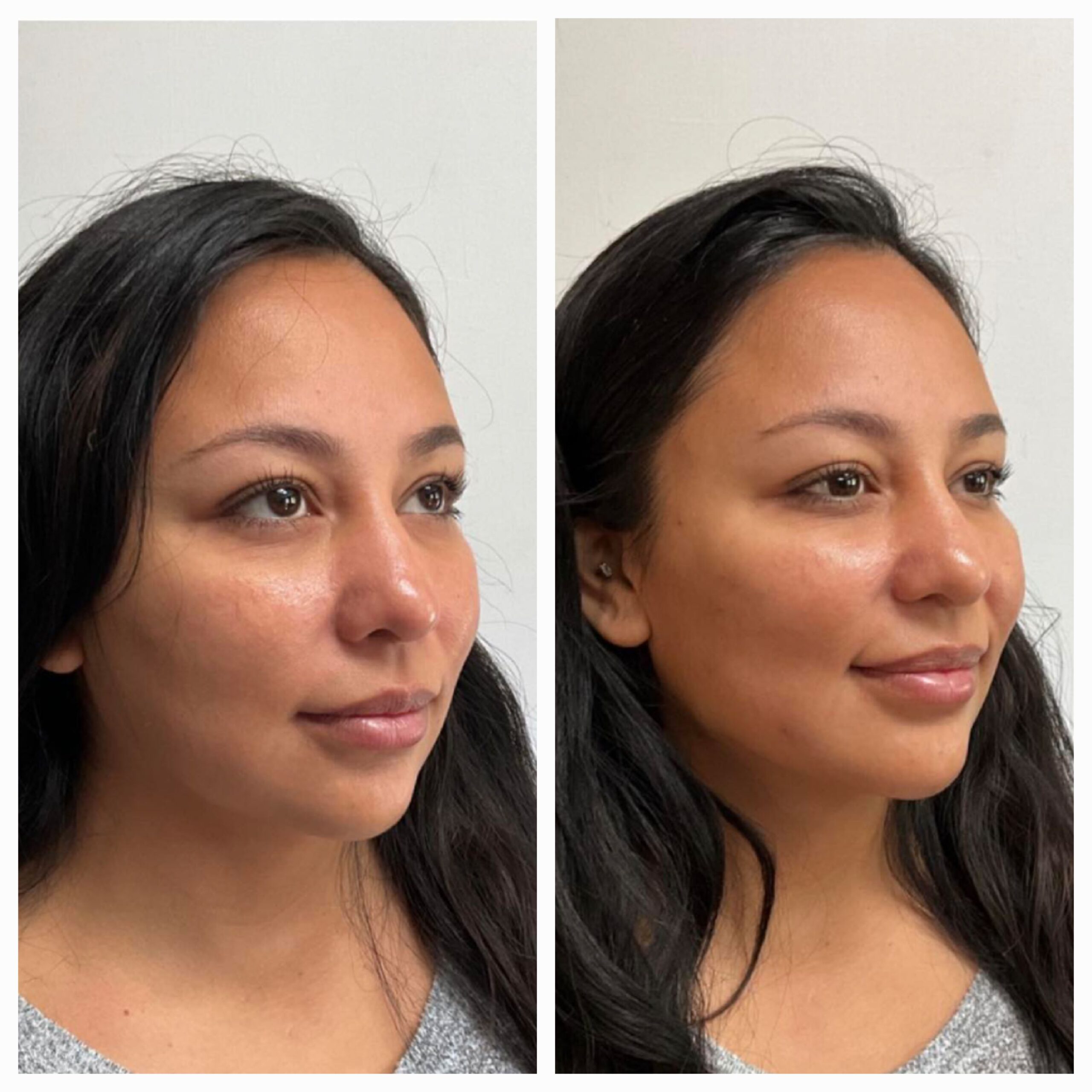 Before and after for 8-point Lift treatment from New Leaf Restorative Medicine- 5