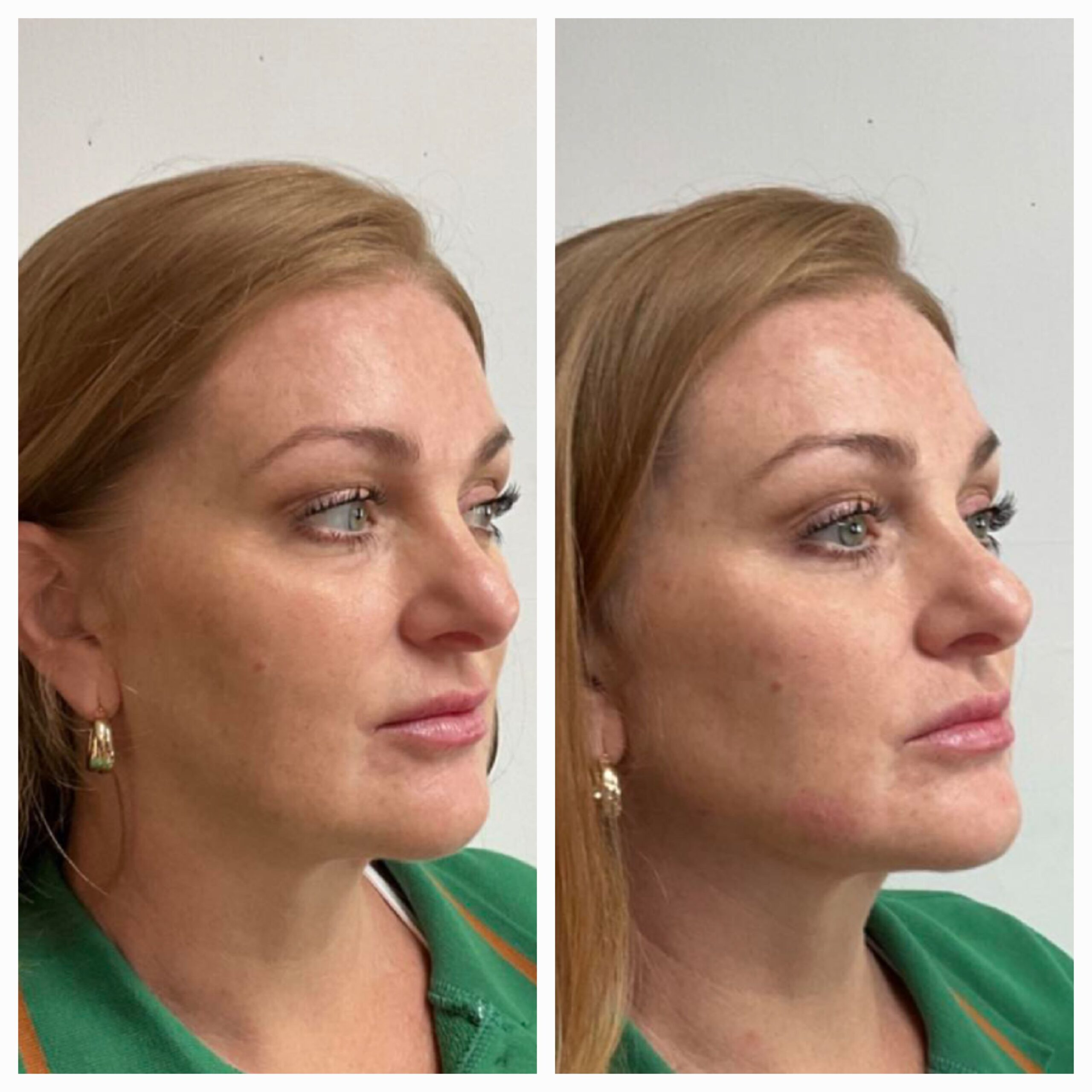 Before and after for 8-point Lift treatment from New Leaf Restorative Medicine-9