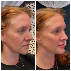 Before and after for 8-point Lift treatment from New Leaf Restorative Medicine- 7