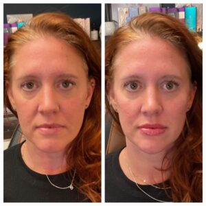 Before and after for 8-point Lift treatment from New Leaf Restorative Medicine-11