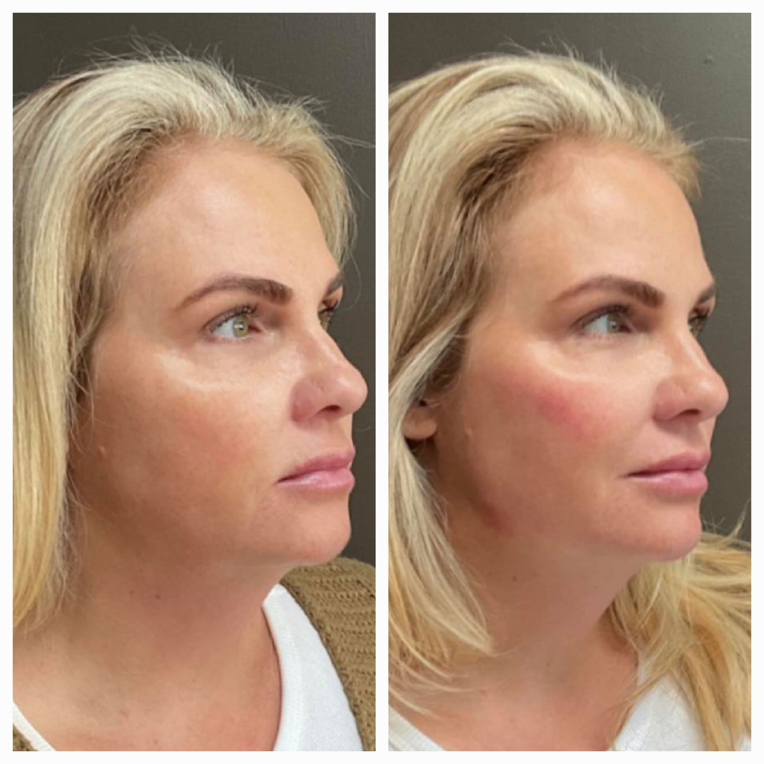 Before and after for 8-point Lift treatment from New Leaf Restorative Medicine-10