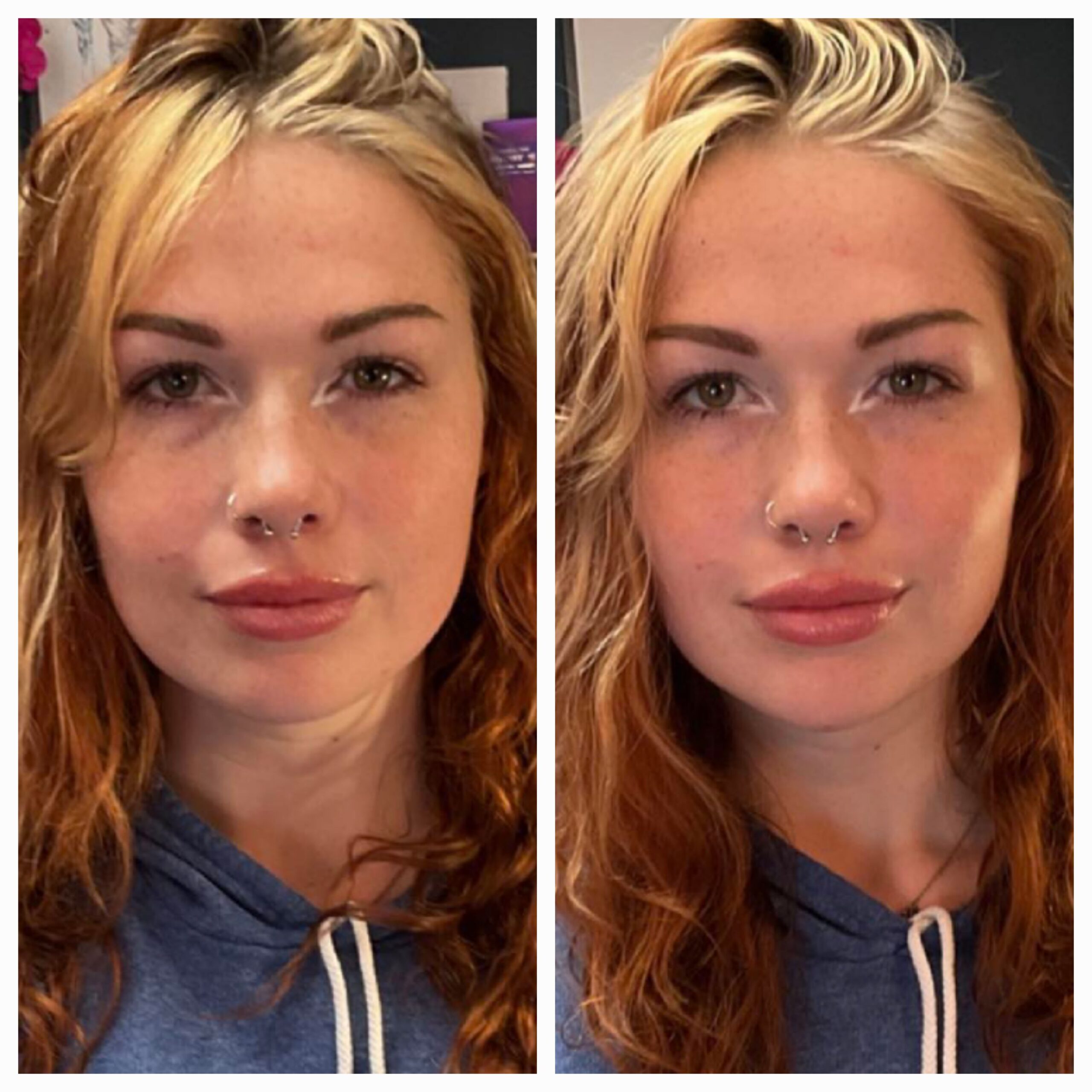 Before and after for 8-point Lift treatment from New Leaf Restorative Medicine- 3