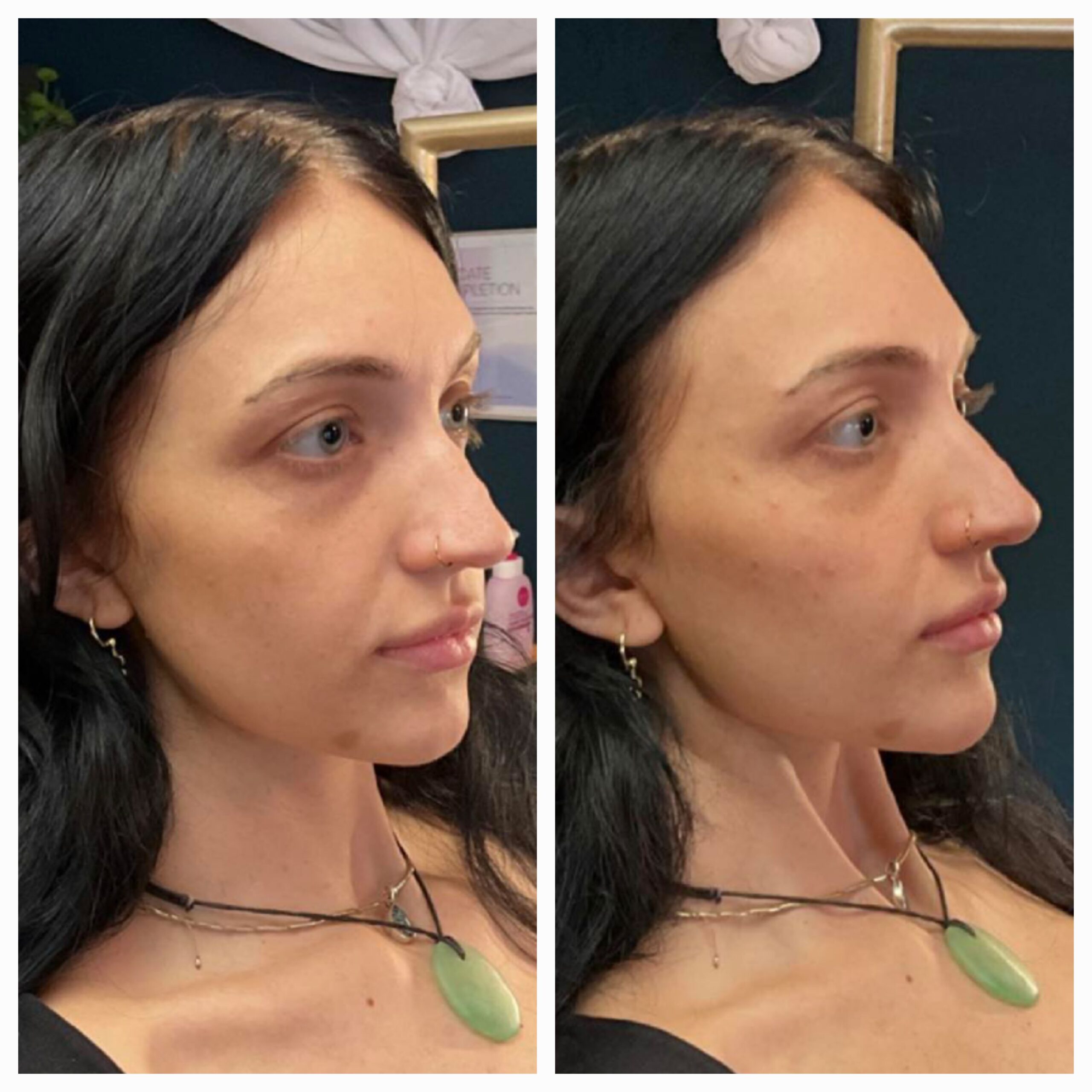 Filler before and after by New Leaf Restorative Medicine