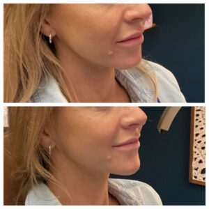 Before and after from New Leaf Restorative Medicine