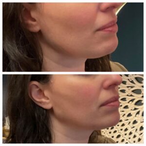 Filler before and after by New Leaf Restorative Medicine