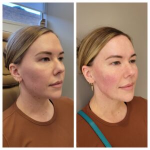 Before and after for 8-point Lift treatment from New Leaf Restorative Medicine- 2