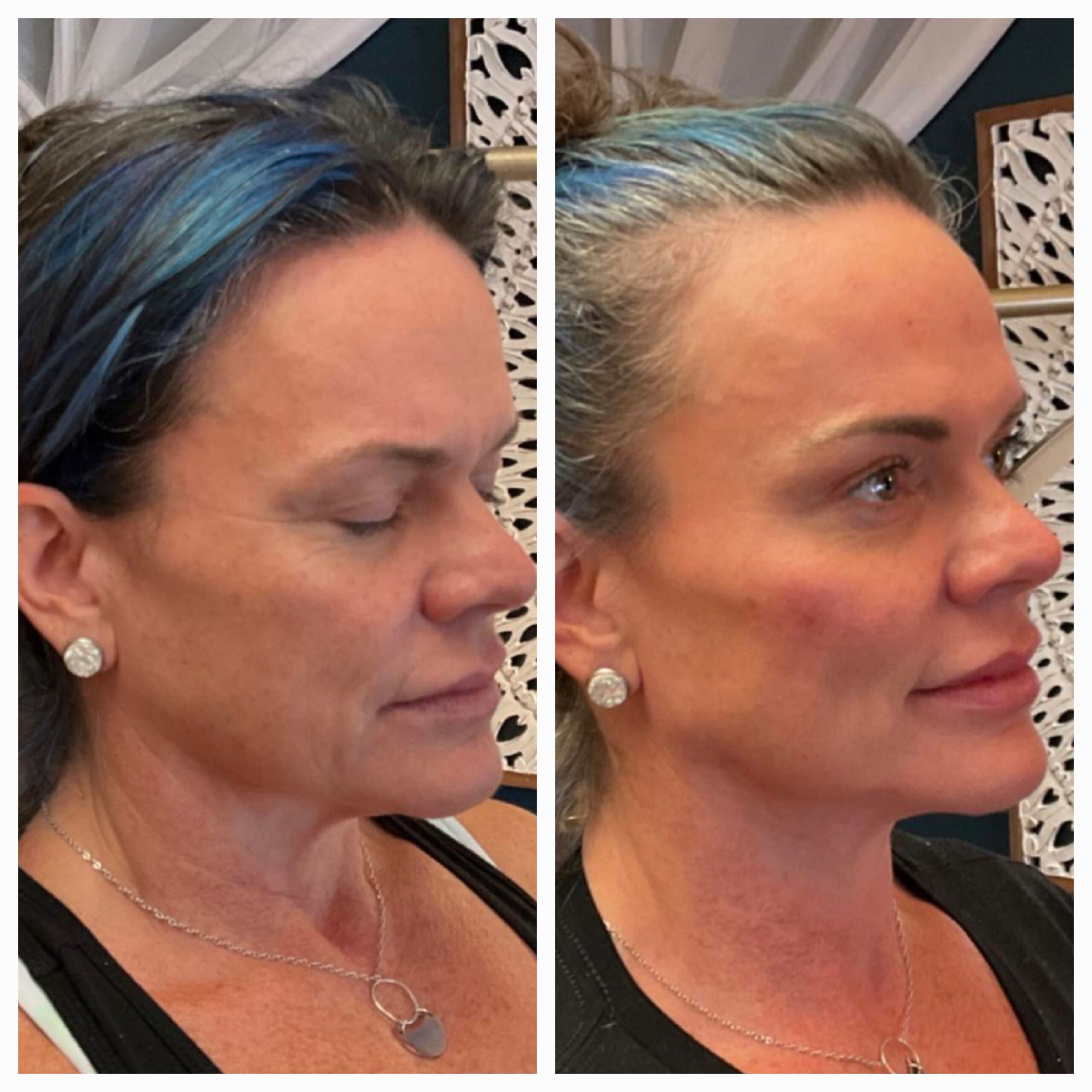 Before and after for 8-point Lift treatment from New Leaf Restorative Medicine-8