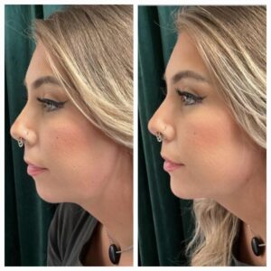 Filler before and after by New Leaf Restorative Medicine