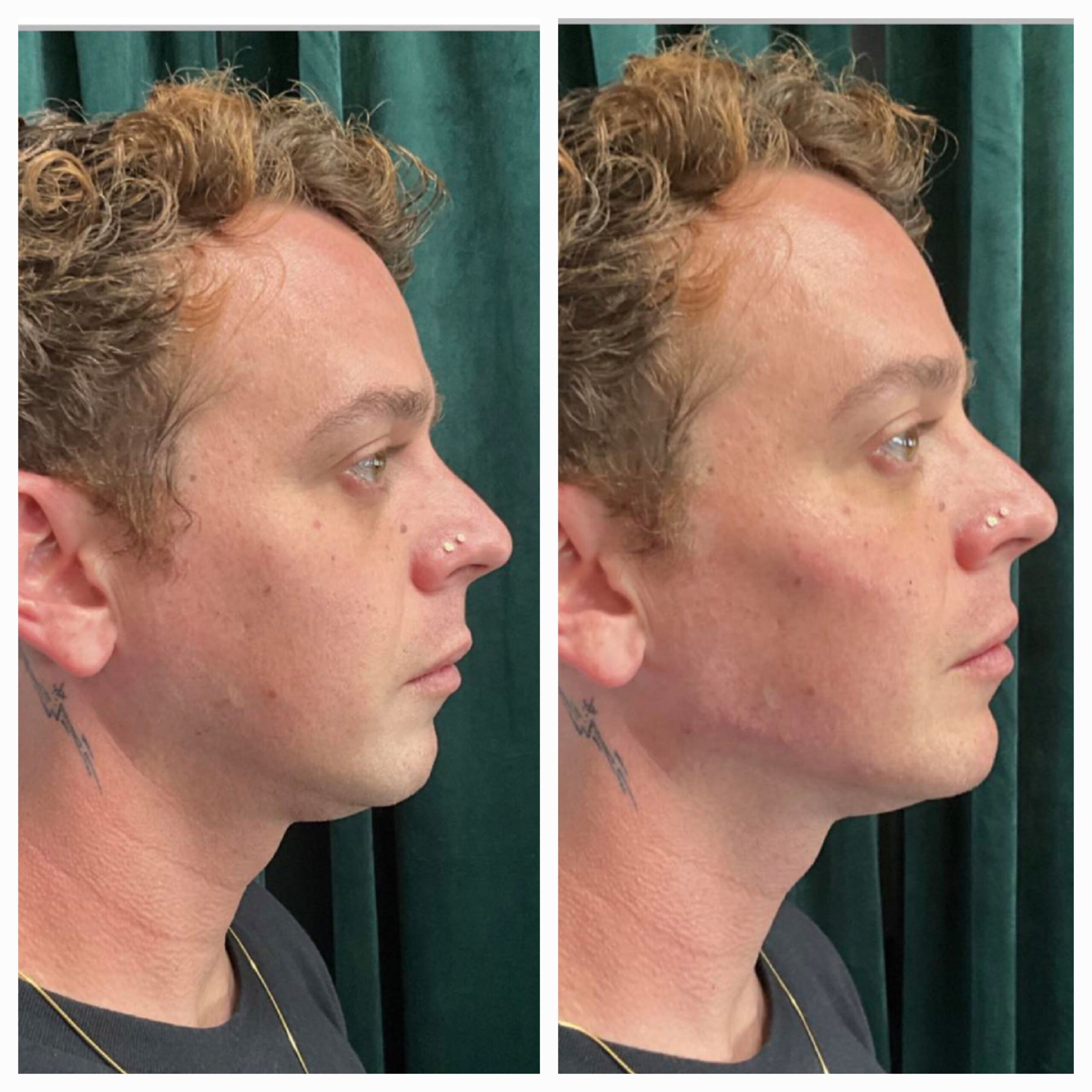 Filler before and after by New Leaf Restorative Medicine