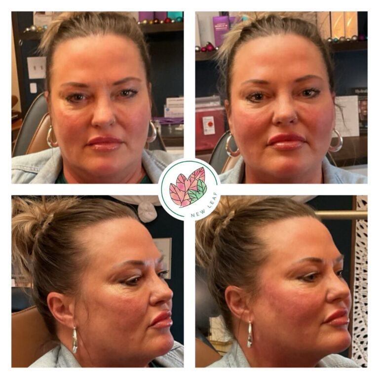 Thread before and after by New Leaf Restorative Medicine