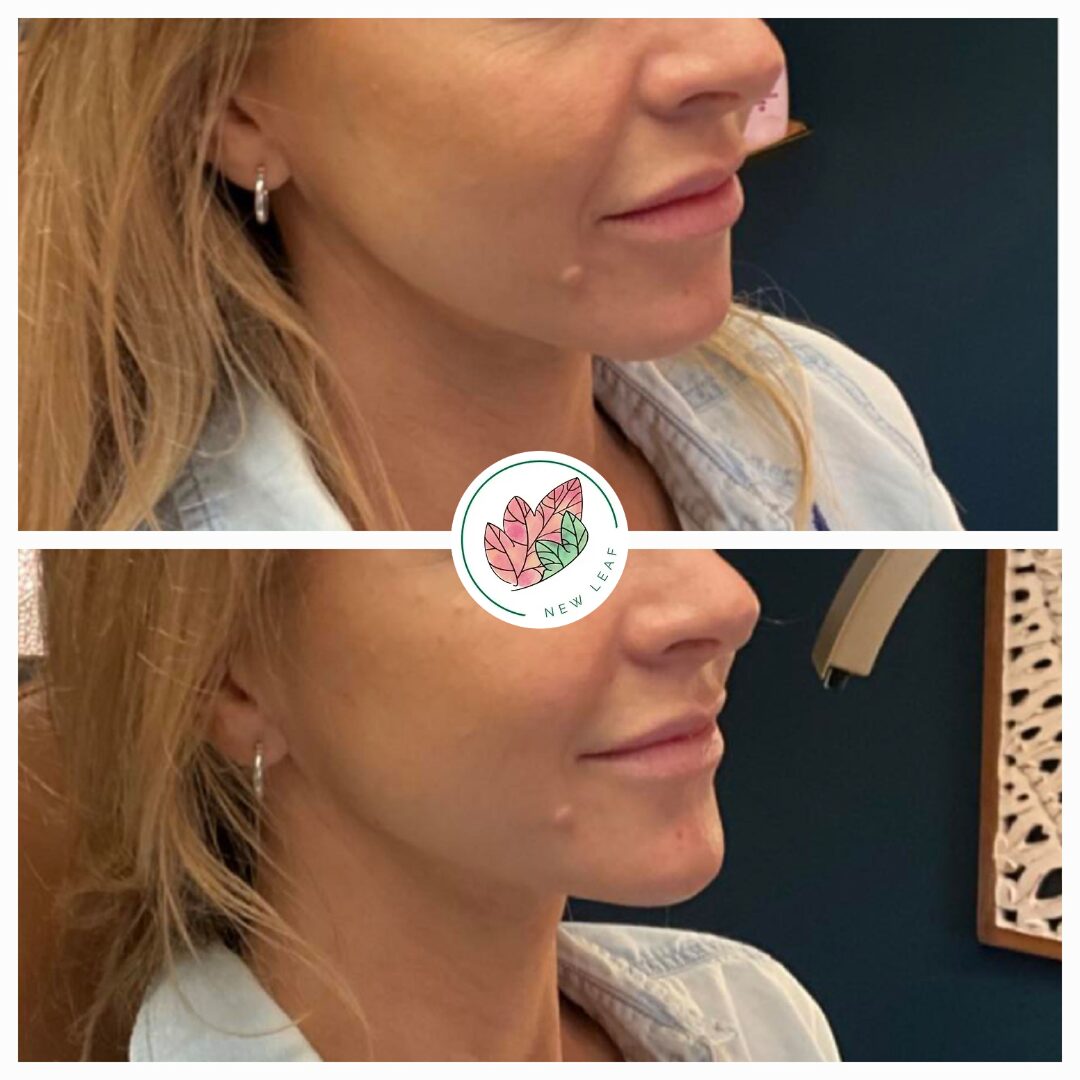 Chin Filler before and after by New Leaf Restorative Medicine